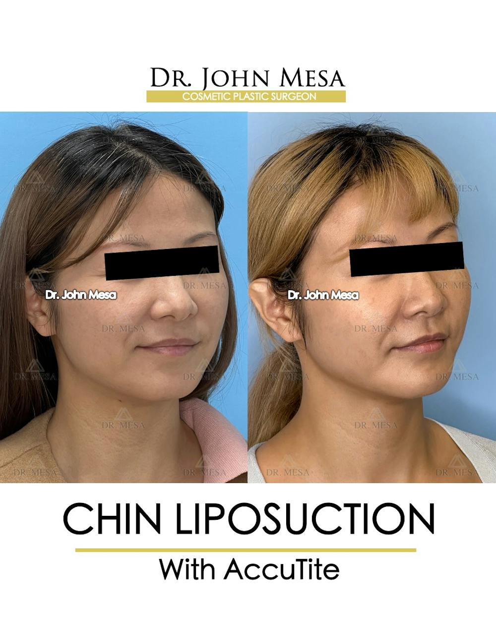 Chin Liposuction Before & After Gallery - Patient 400704 - Image 2