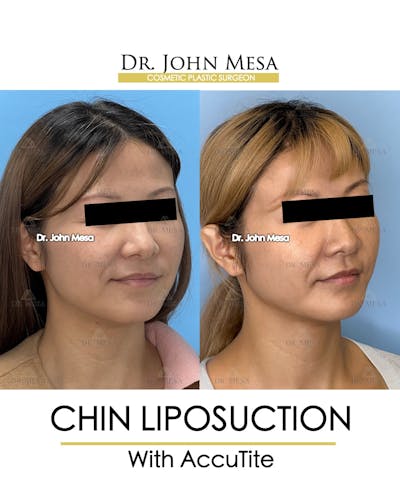 Chin Liposuction Before & After Gallery - Patient 400704 - Image 2