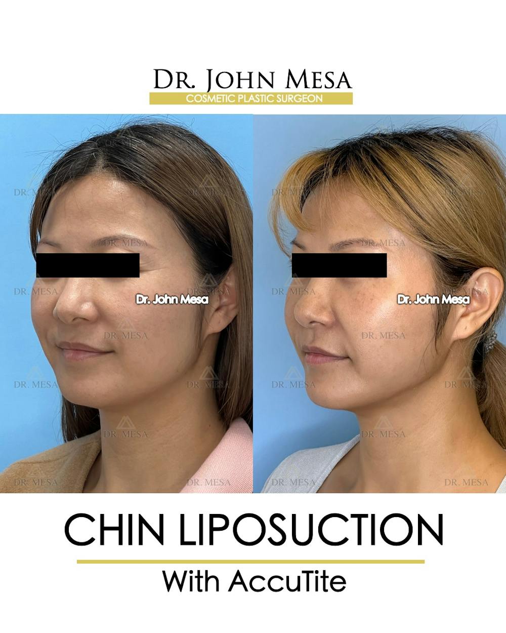 Chin Liposuction Before & After Gallery - Patient 400704 - Image 4