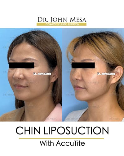 Chin Liposuction Before & After Gallery - Patient 400704 - Image 4