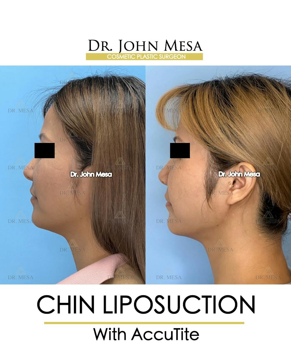Chin Liposuction Before & After Gallery - Patient 400704 - Image 5
