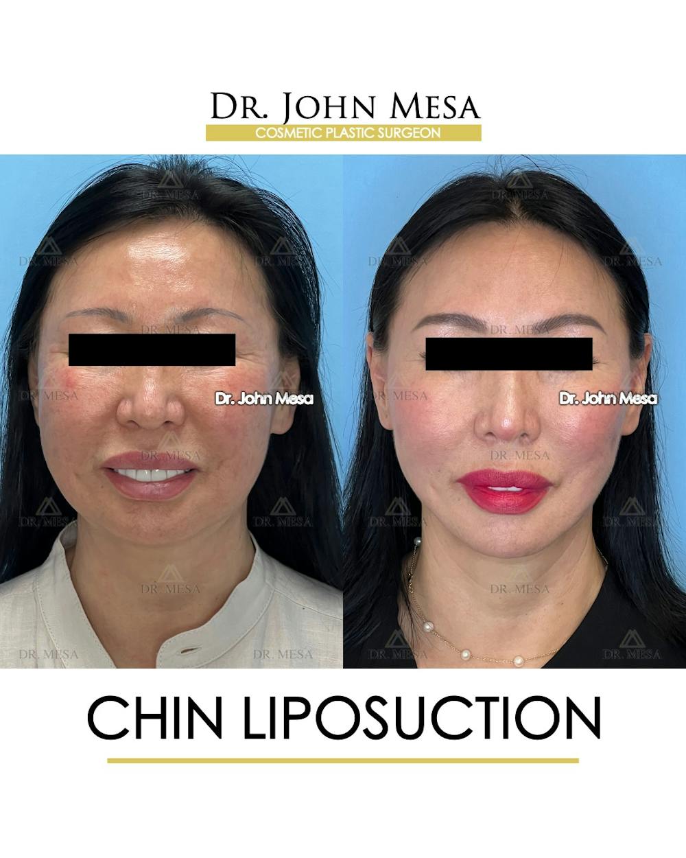 Chin Liposuction Before & After Gallery - Patient 410840 - Image 2