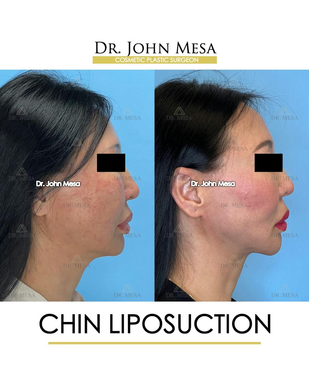 Chin Liposuction Before & After Gallery - Patient 410840 - Image 1
