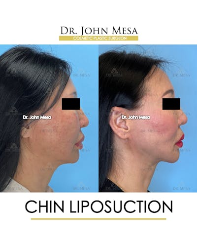 Chin Liposuction Before & After Gallery - Patient 410840 - Image 4