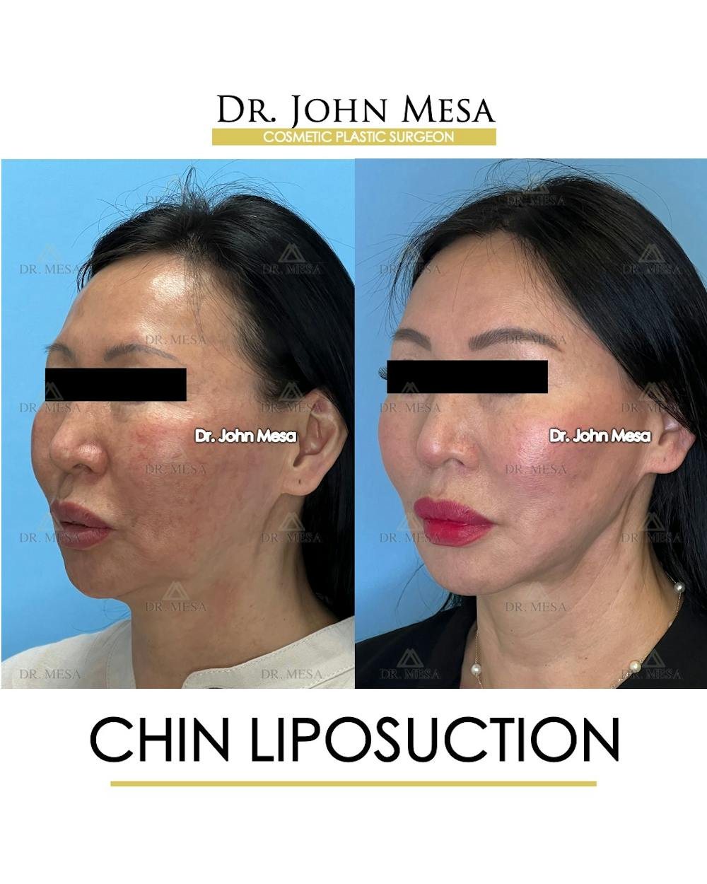 Chin Liposuction Before & After Gallery - Patient 410840 - Image 5