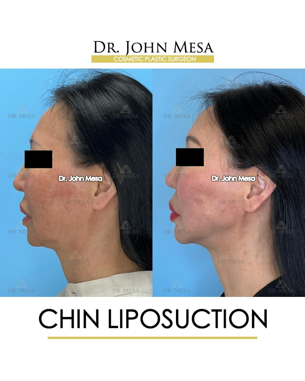 Chin Liposuction Before & After Gallery - Patient 410840 - Image 6