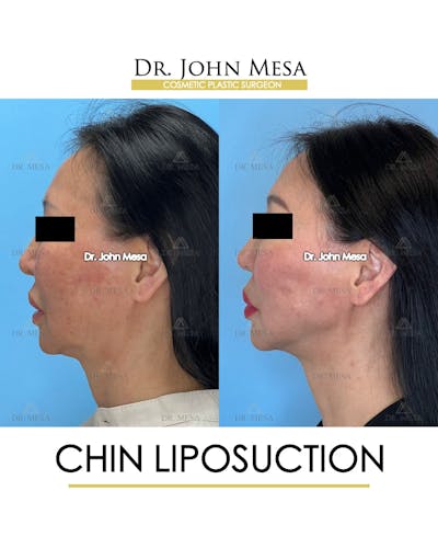 Chin Liposuction Before & After Gallery - Patient 410840 - Image 6