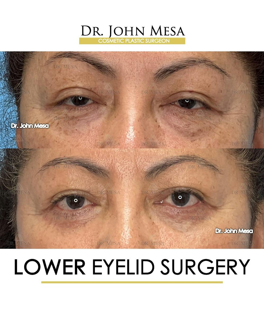 Eyelid Lift Surgery Before & After Gallery - Patient 298855 - Image 1
