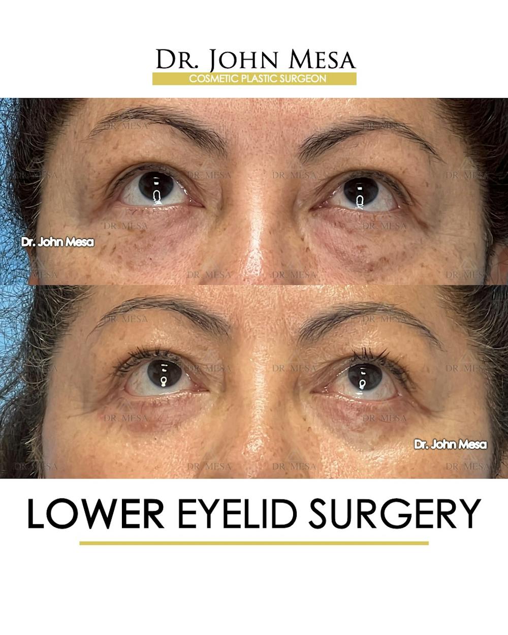 Eyelid Lift Surgery Before & After Gallery - Patient 298855 - Image 2