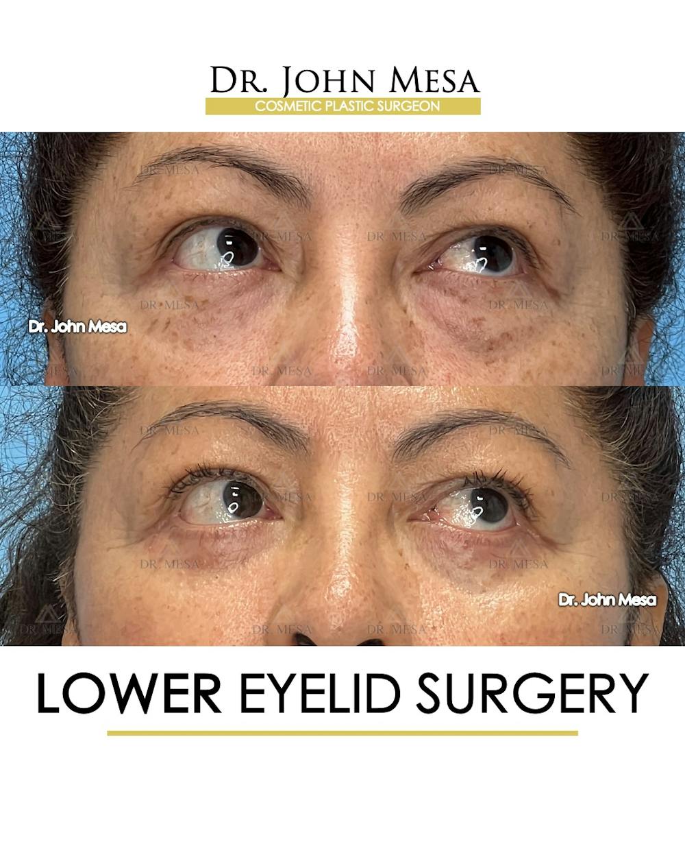 Eyelid Lift Surgery Before & After Gallery - Patient 298855 - Image 3