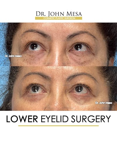 Eyelid Lift Surgery Before & After Gallery - Patient 298855 - Image 4