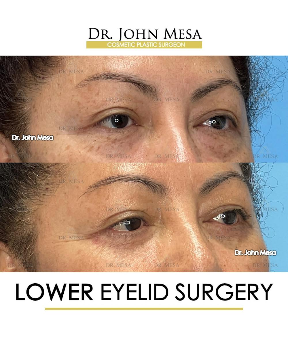 Eyelid Lift Surgery Before & After Gallery - Patient 298855 - Image 5