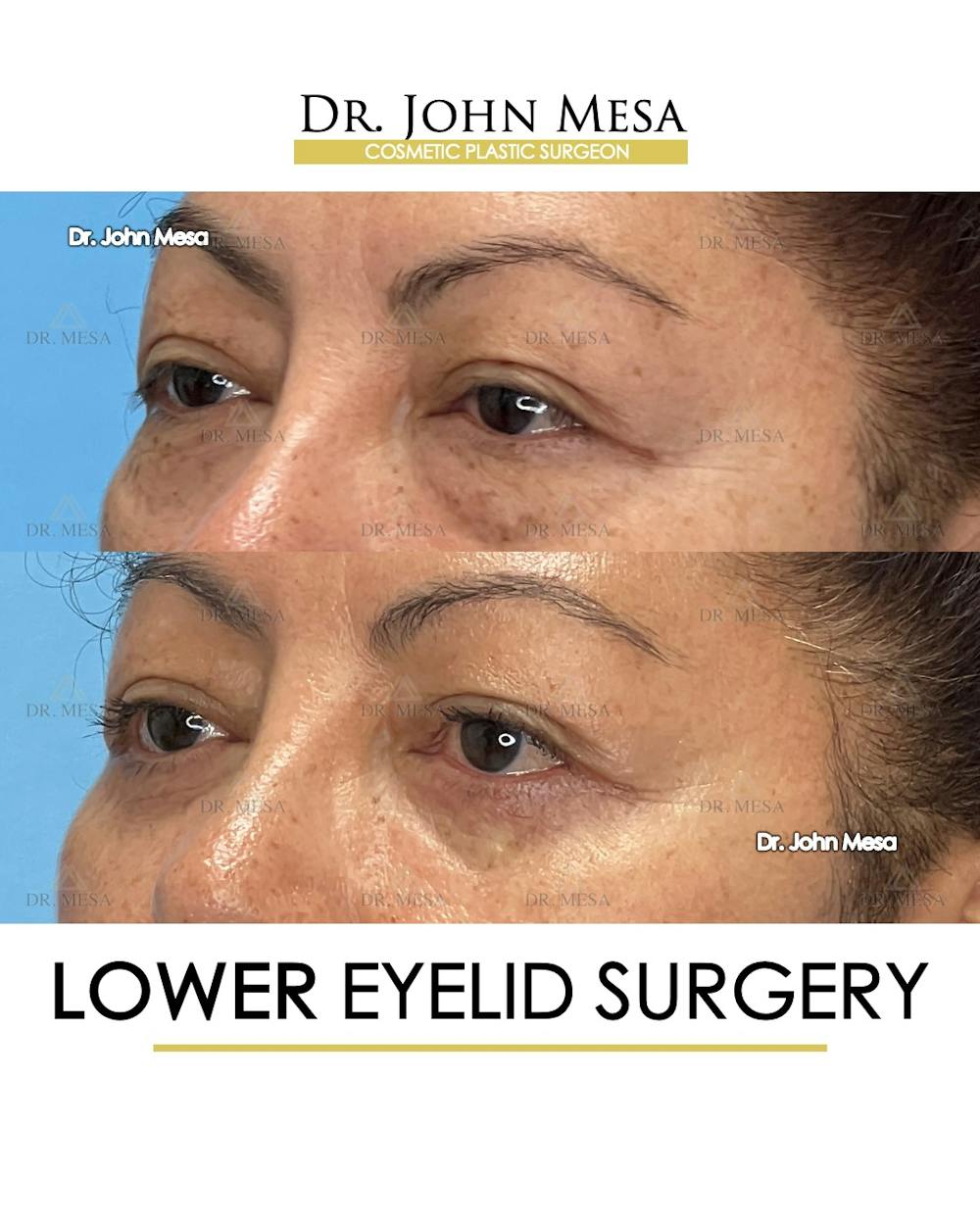Eyelid Lift Surgery Before & After Gallery - Patient 298855 - Image 6