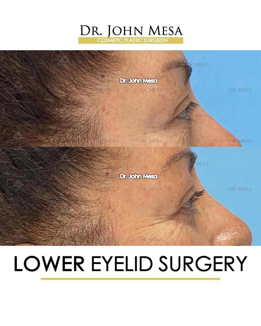 Eyelid Lift Surgery Before & After Gallery - Patient 298855 - Image 7