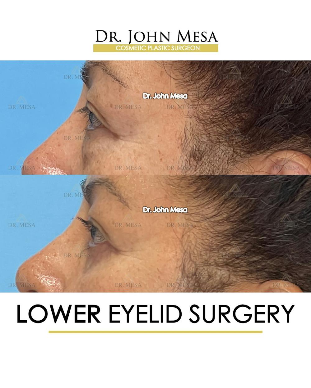 Eyelid Lift Surgery Before & After Gallery - Patient 298855 - Image 8