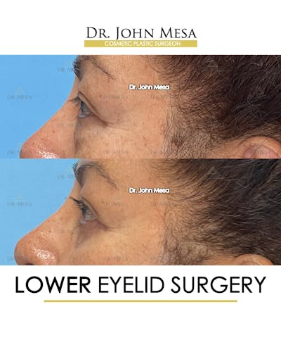 Eyelid Lift Surgery Before & After Gallery - Patient 298855 - Image 8