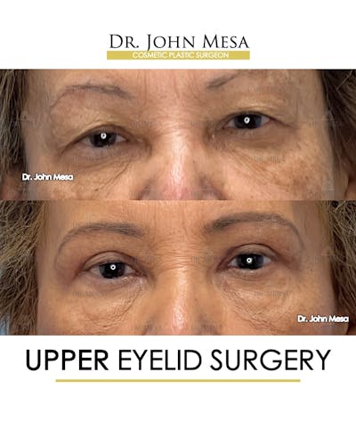 Eyelid Lift Surgery Before & After Gallery - Patient 609672 - Image 1