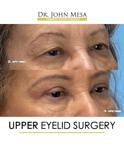 Eyelid Lift Surgery Before & After Gallery - Patient 609672 - Image 2