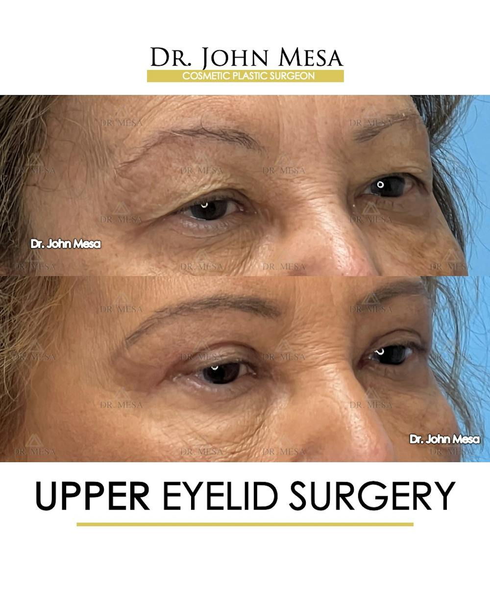 Eyelid Lift Surgery Before & After Gallery - Patient 609672 - Image 2