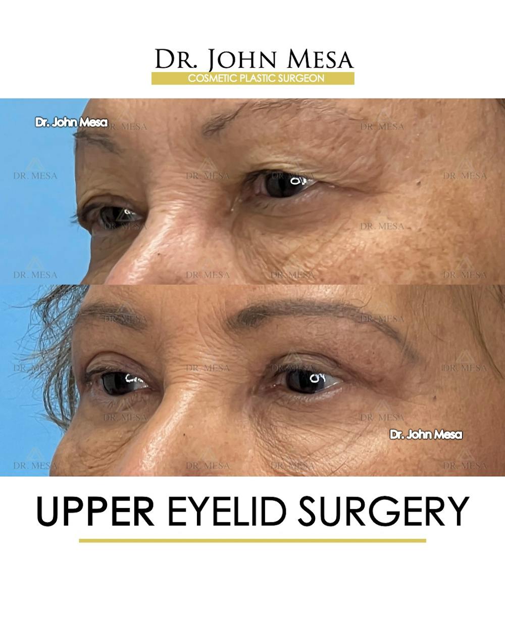 Eyelid Lift Surgery Before & After Gallery - Patient 609672 - Image 3