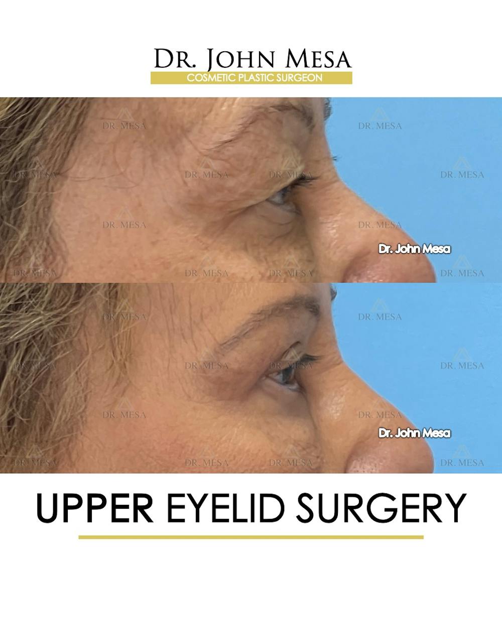 Eyelid Lift Surgery Before & After Gallery - Patient 609672 - Image 4