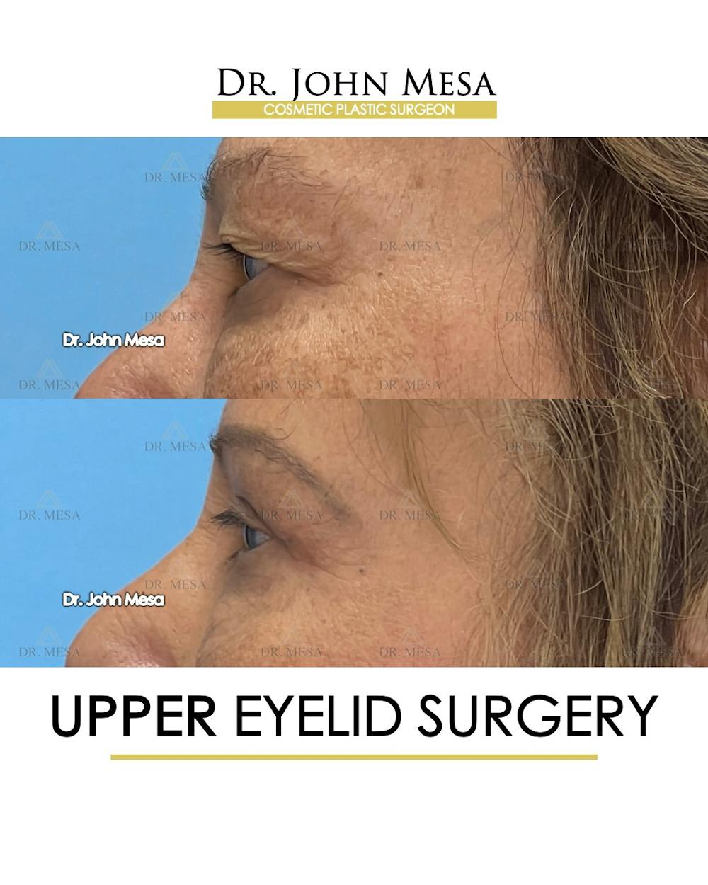 Eyelid Lift Surgery Before & After Gallery - Patient 609672 - Image 5