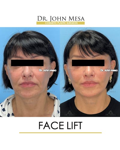 Facelift Before & After Gallery - Patient 712304 - Image 1