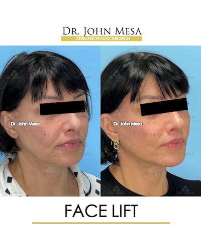 Facelift Before & After Gallery - Patient 712304 - Image 2