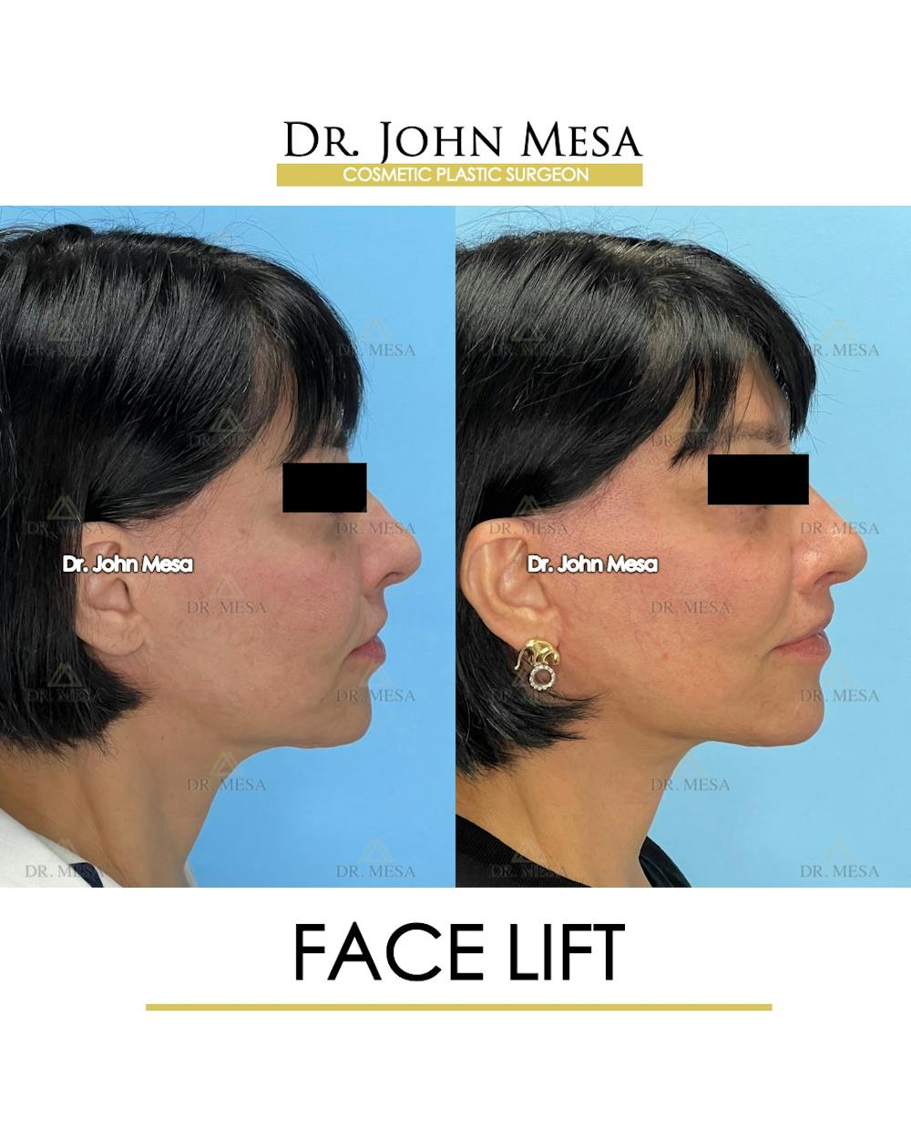 Facelift Before & After Gallery - Patient 712304 - Image 3