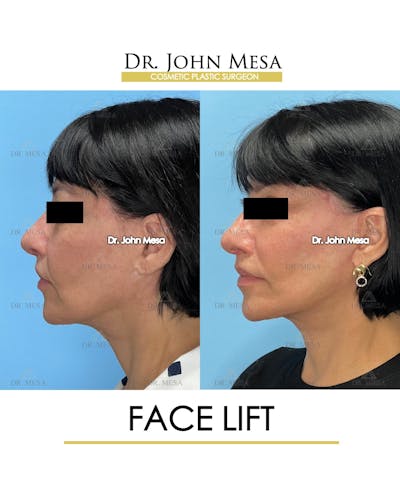 Facelift Before & After Gallery - Patient 712304 - Image 4