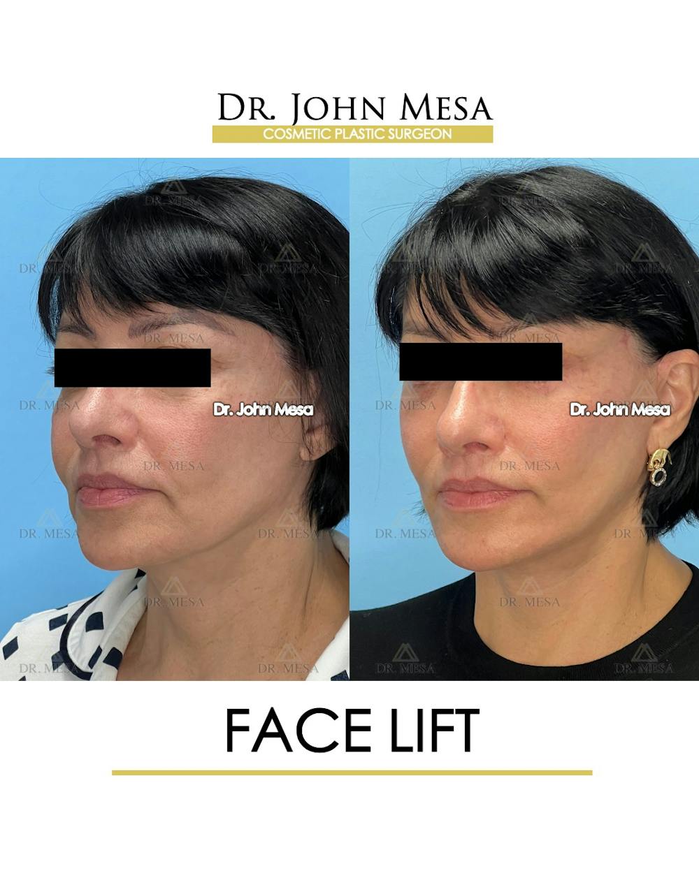 Facelift Before & After Gallery - Patient 712304 - Image 5