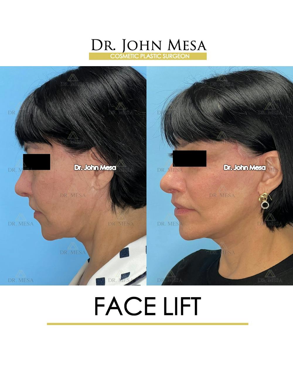 Facelift Before & After Gallery - Patient 712304 - Image 6