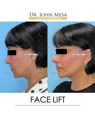 Facelift Before & After Gallery - Patient 712304 - Image 6