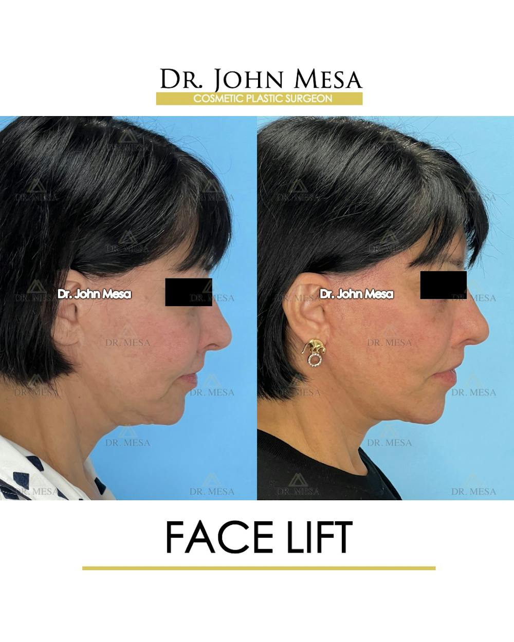 Facelift Before & After Gallery - Patient 712304 - Image 7