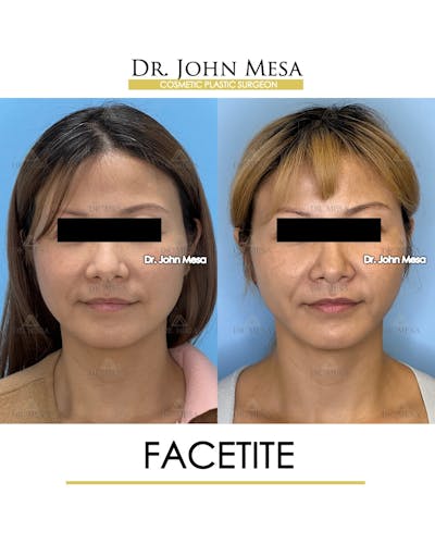 FaceTite Before & After Gallery - Patient 116308 - Image 1