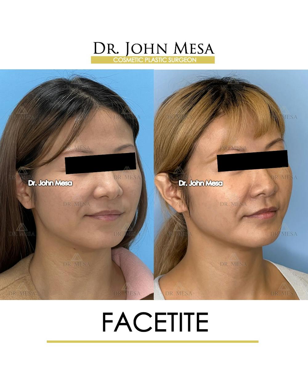 FaceTite Before & After Gallery - Patient 116308 - Image 2