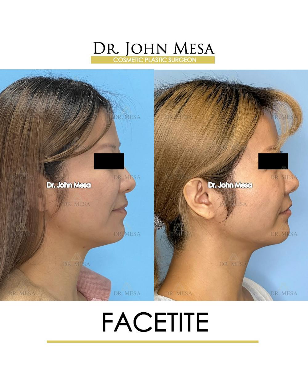 FaceTite Before & After Gallery - Patient 116308 - Image 3