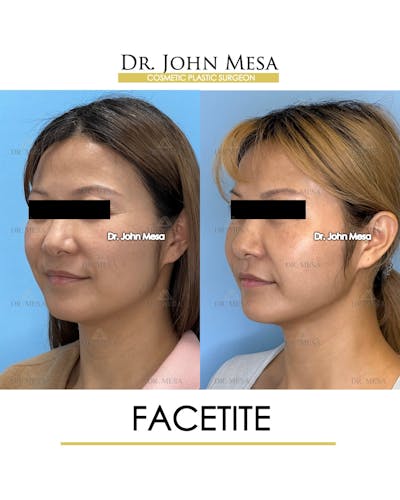 FaceTite Before & After Gallery - Patient 116308 - Image 4