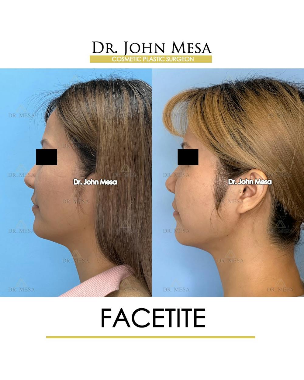 FaceTite Before & After Gallery - Patient 116308 - Image 5