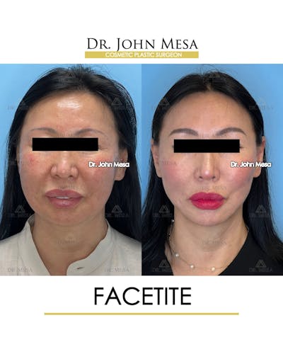 FaceTite Before & After Gallery - Patient 167164 - Image 1