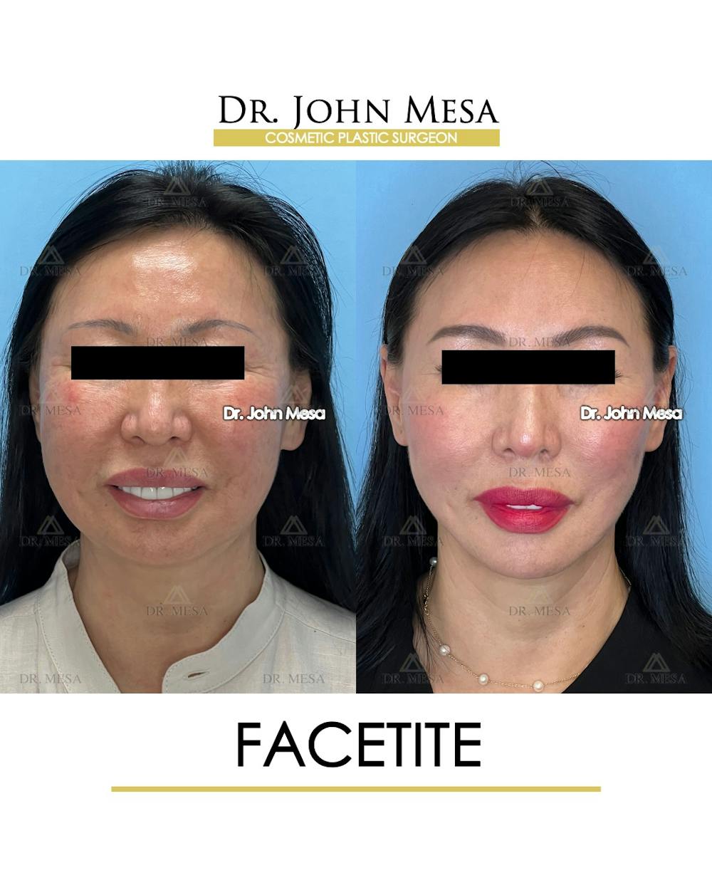 FaceTite Before & After Gallery - Patient 167164 - Image 2