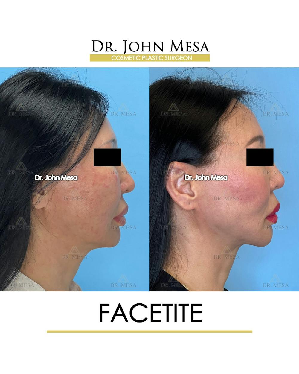 FaceTite Before & After Gallery - Patient 167164 - Image 4