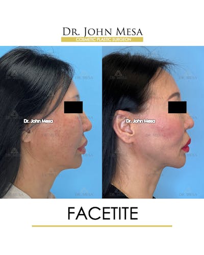 FaceTite Before & After Gallery - Patient 167164 - Image 4