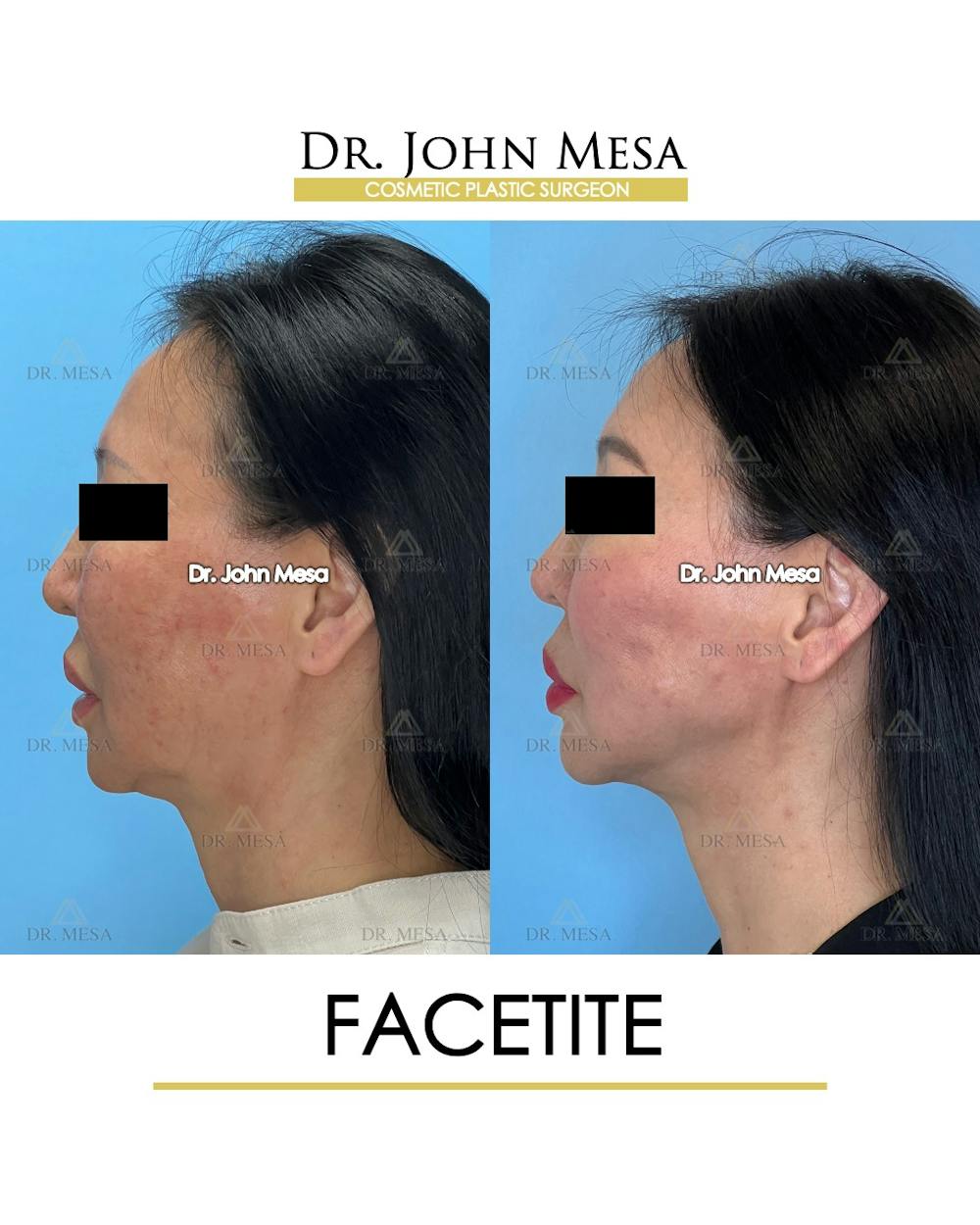 FaceTite Before & After Gallery - Patient 167164 - Image 6
