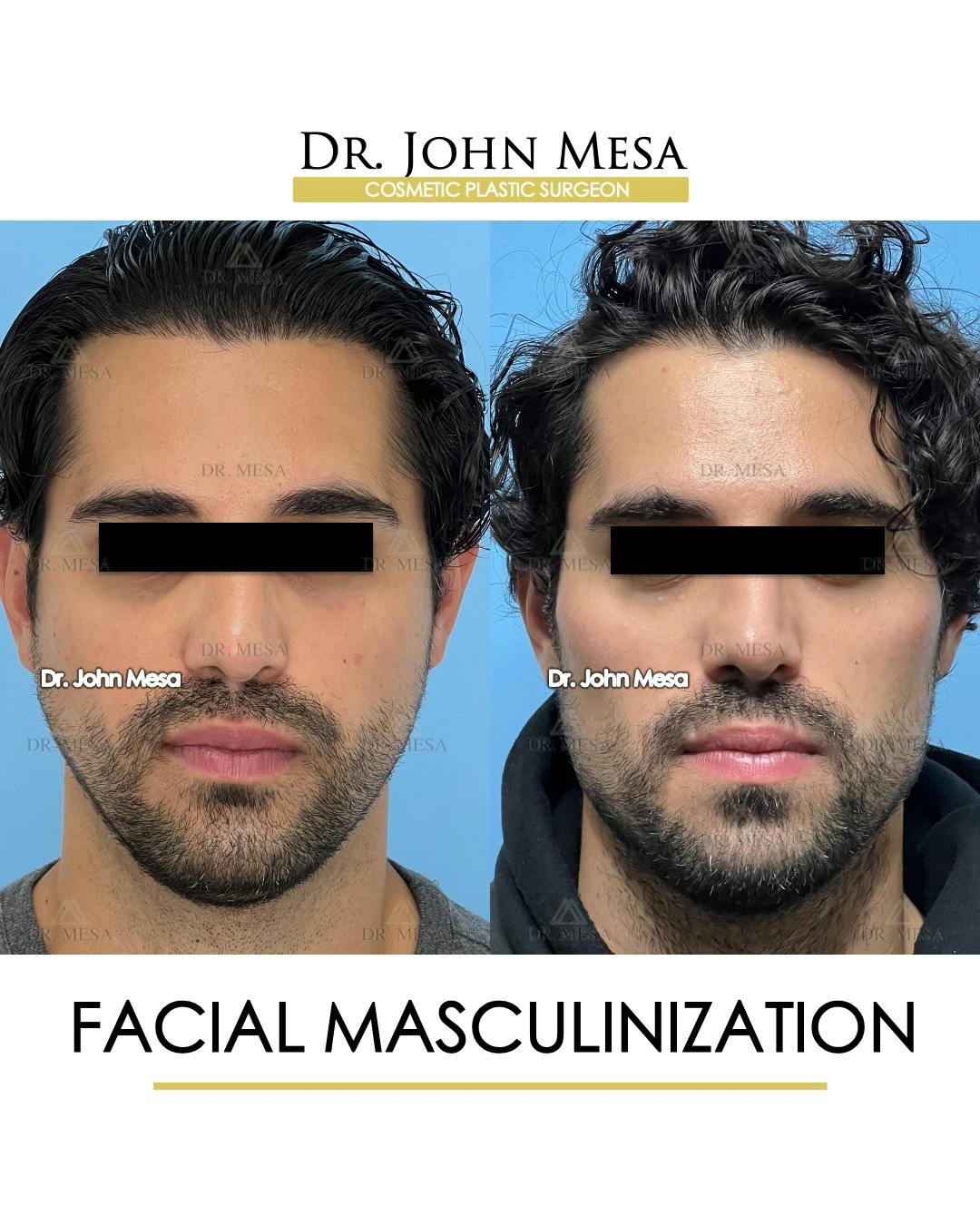 Facial Masculinization Before & After Gallery - Patient 227524 - Image 1