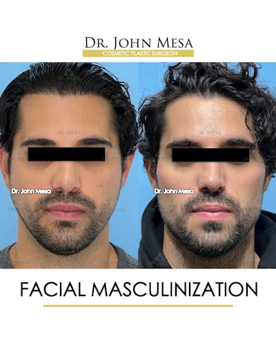 Facial Masculinization Before & After Gallery - Patient 227524 - Image 1