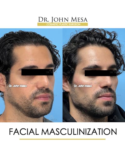 Facial Masculinization Before & After Gallery - Patient 227524 - Image 2