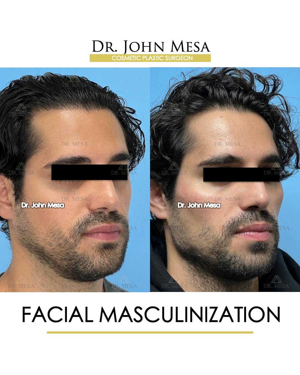 Facial Masculinization Before & After Gallery - Patient 227524 - Image 2