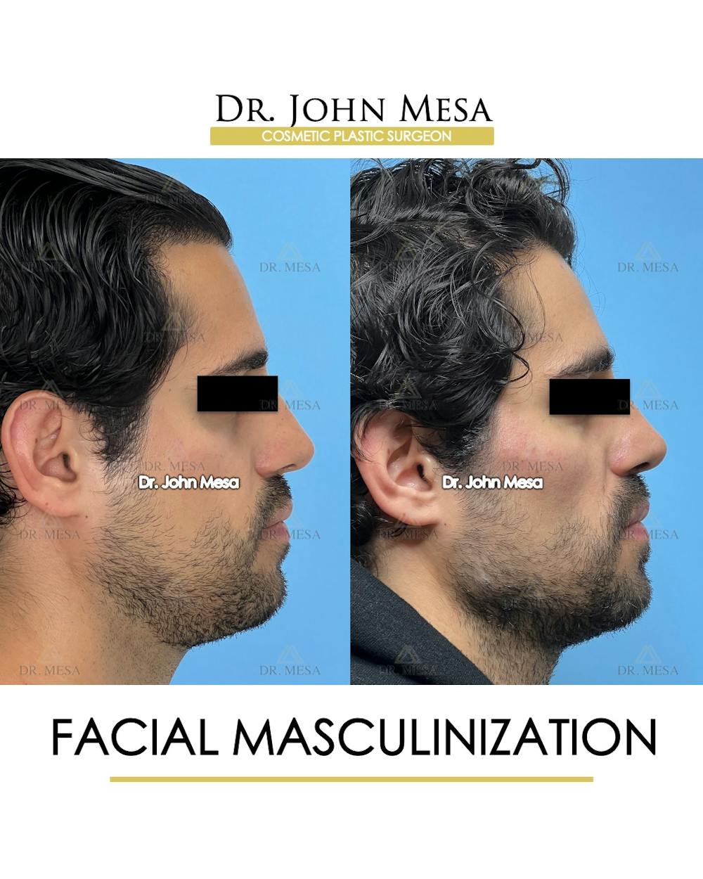 Facial Masculinization Before & After Gallery - Patient 227524 - Image 3