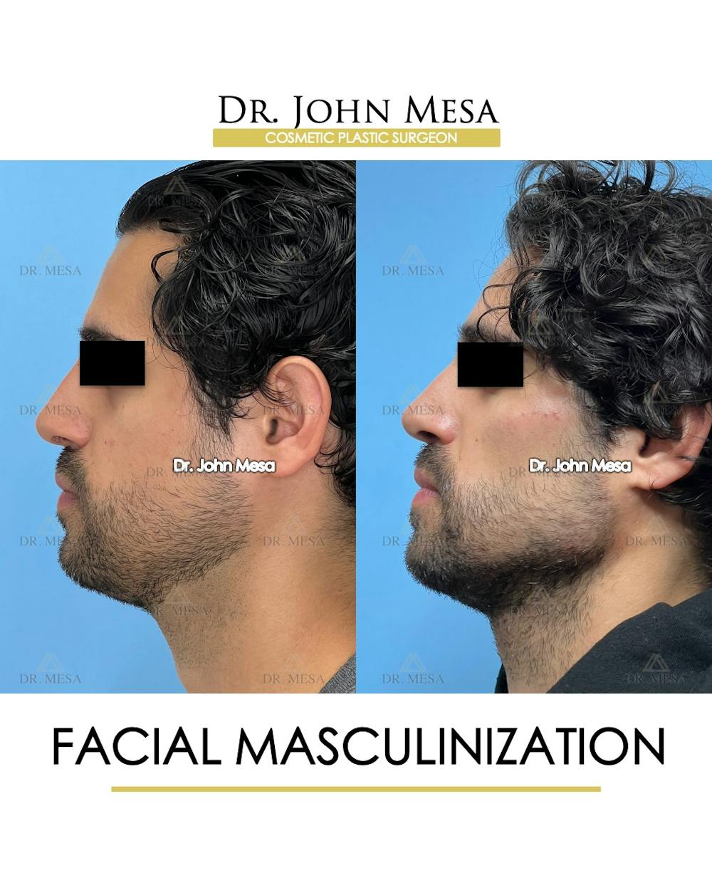 Facial Masculinization Before & After Gallery - Patient 227524 - Image 5